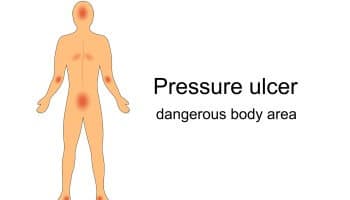 areas body prone pressure sore