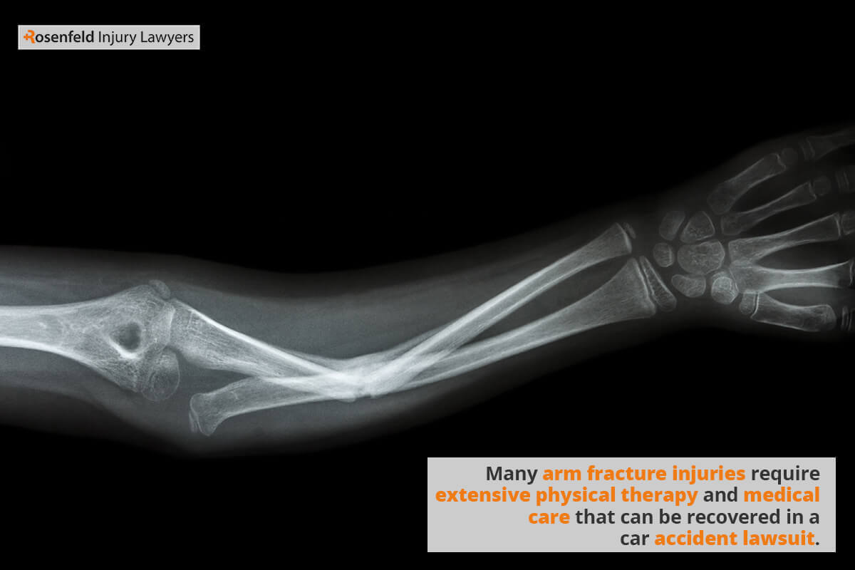 Many arm fracture injuries require extensive physical therapy and medical care that can be recovered in a car accident lawsuit.