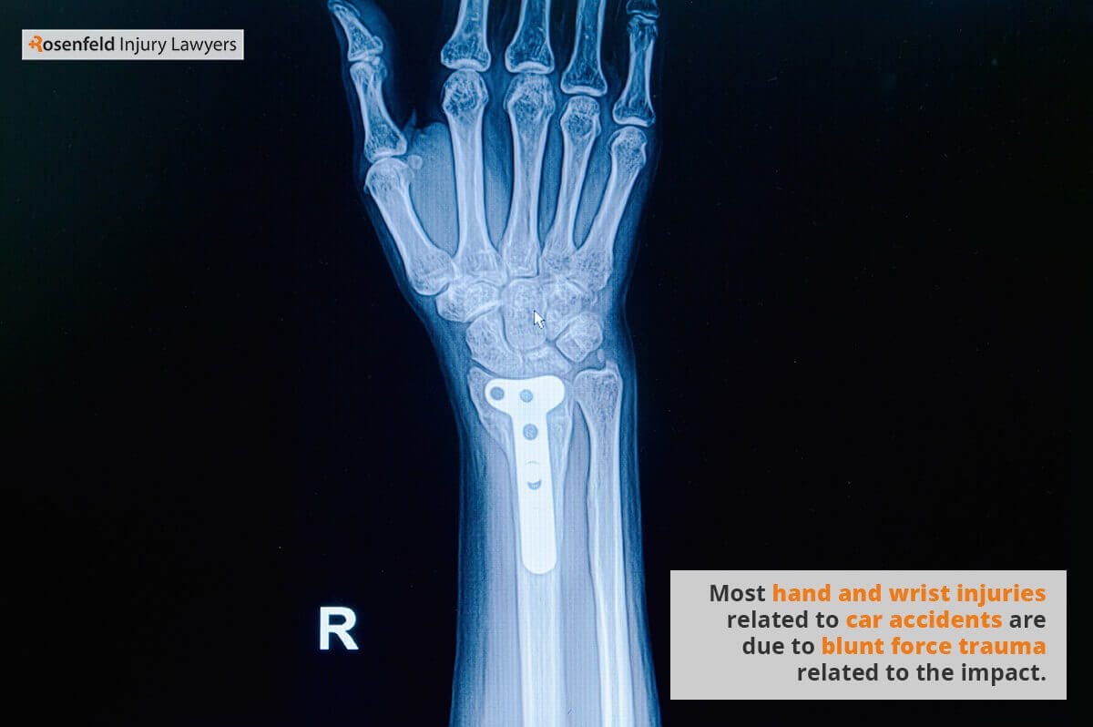 Most hand and wrist injuries related to car accidents are due to blunt force trauma related to the impact.