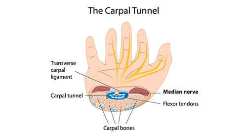 How to win a carpal tunnel workers' comp claim