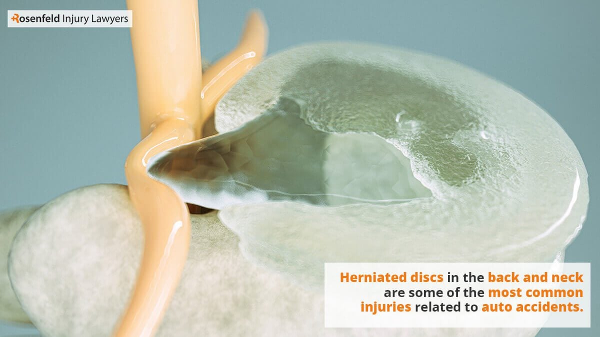 Herniated disc injuries related to car accidents tend to be some of the most disputed injury claims.