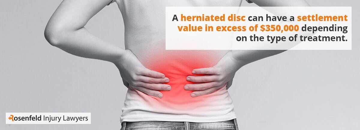 A herniated disc can have a settlement value in excess of $350,000 depending on the type of treatment.