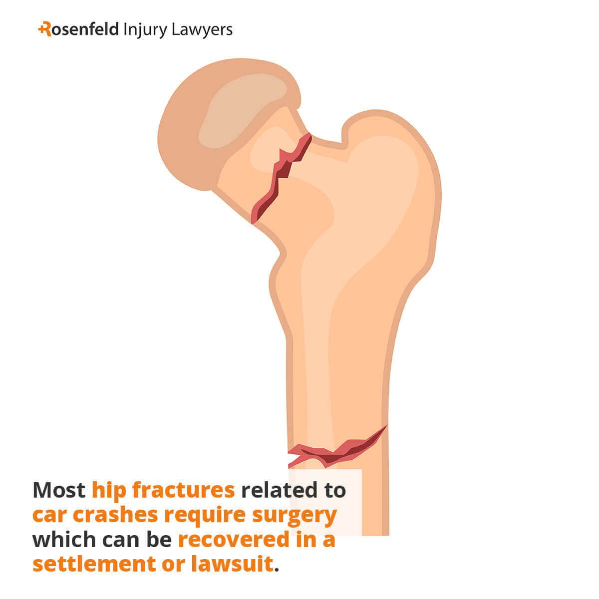 Most hip fractures related to car crashes require surgery which can be recovered in a settlement or lawsuit.