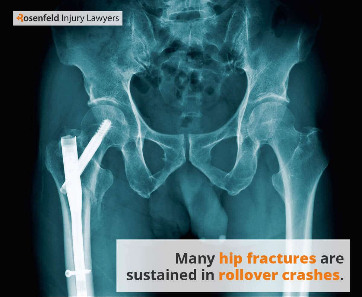 Many hip fractures are sustained in rollover crashes.