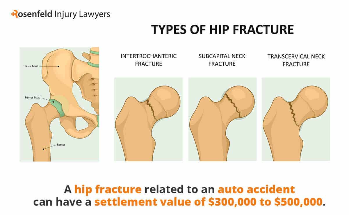 A hip fracture related to an auto accident can have a settlement value of $300,000 to $500,000.