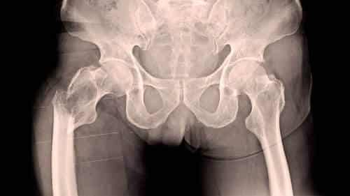 hip injury from car accident