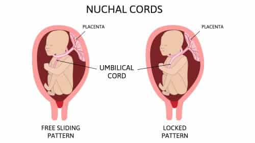 nuchal cord birth injury lawsuits