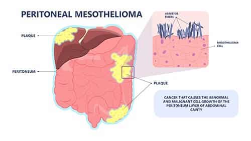 What is Peritoneal Mesothelioma