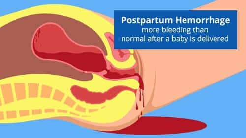 postpartum-hemorrhage-malpractice-lawsuit