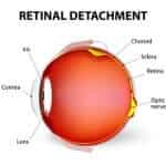 Detachment of the Retina