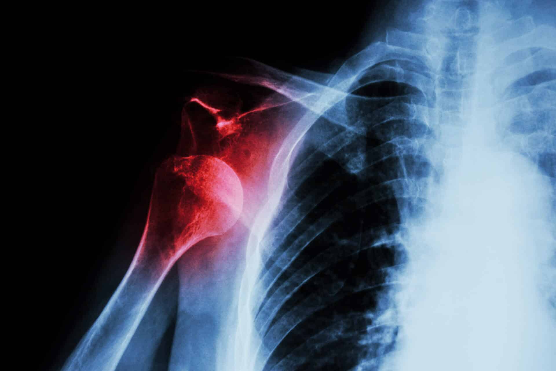 Shoulder Pain After a Car Accident