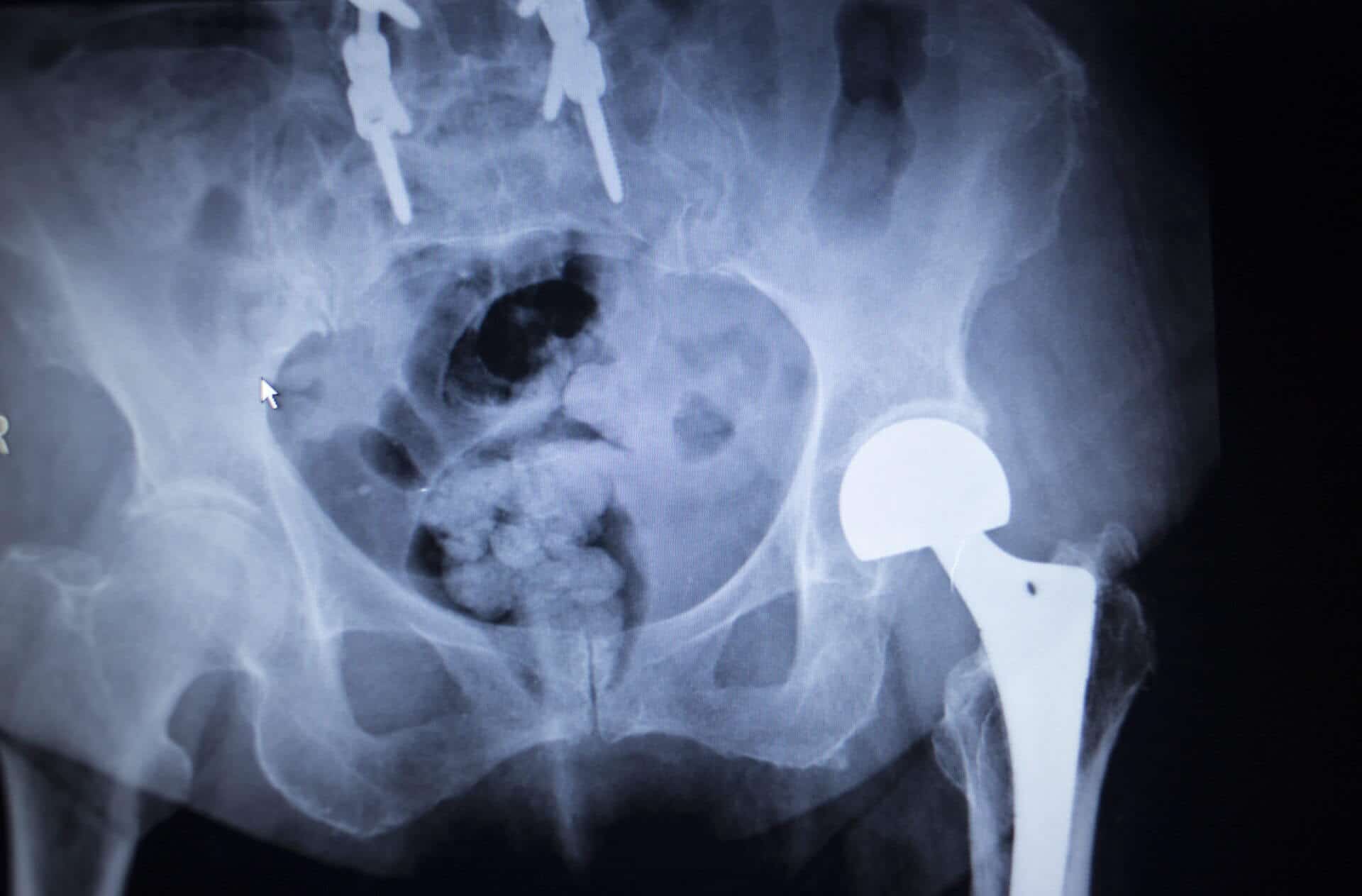 Stryker hip replacement lawsuit