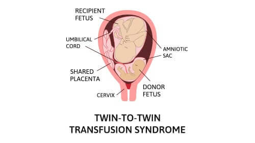 twin-to-twin transfusion syndrome (TTTS) attorney