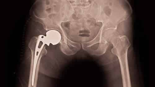 What are the risks associated with a hip revision surgery?