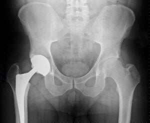 Zimmer Hip Replacement Lawsuit
