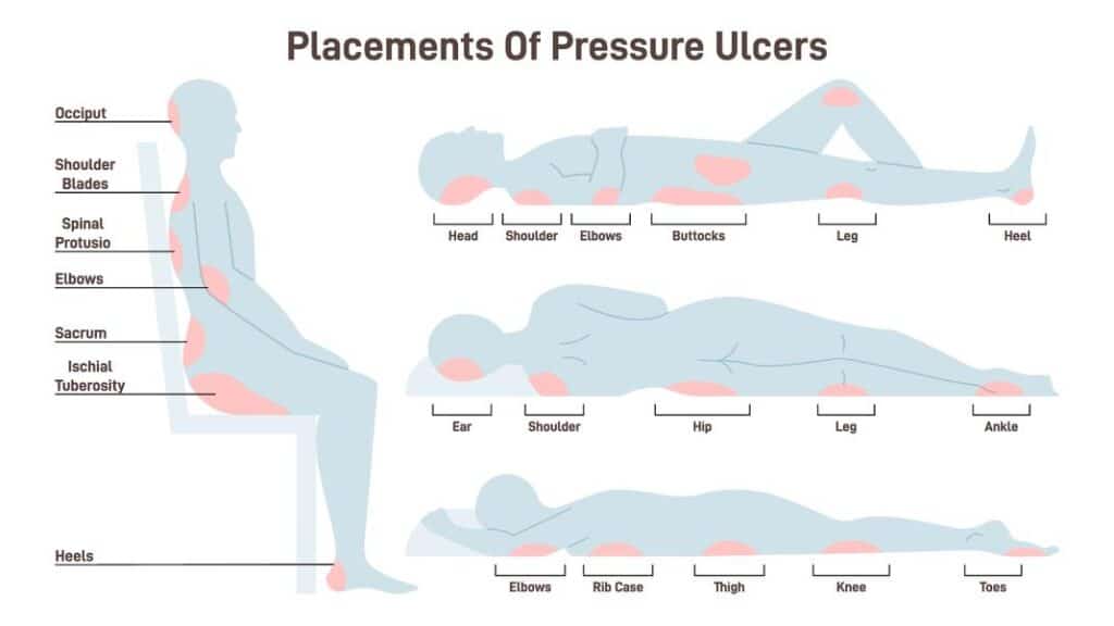 areas where pressure ulcers most commonly appear