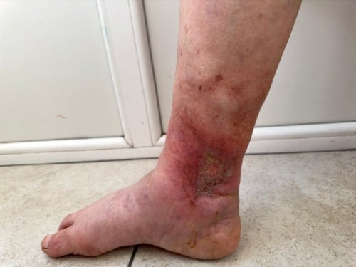 suspected deep tissue injury on ankle
